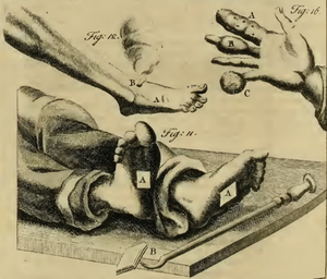Despite dismissing the practice, Lorenz Heister provided an image of moxibustion (Fig. 12) with a dry (A) and ignited (B) pellet.