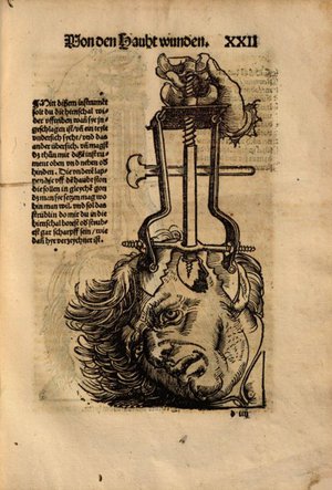 Hans Von Gersdorff, Feldbuch der Wundarzney, 1517.