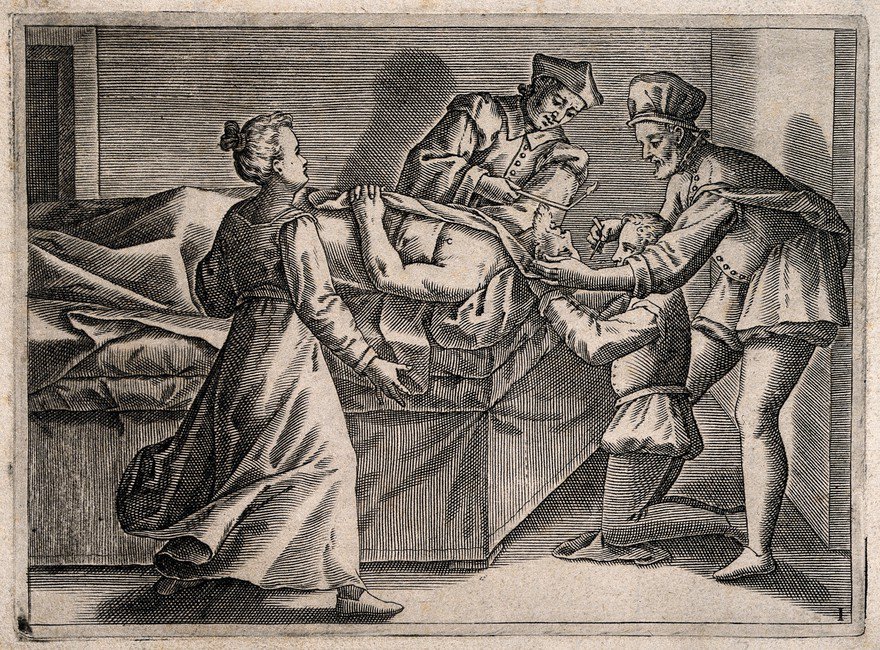 A surgeon bleeding a man's head, he is aided by two assistants, a woman (the patient's wife ?) appears anxious. Engraving, 1586.